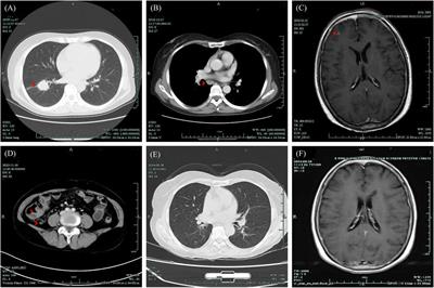 Case report: Alectinib-associated intestinal ulceration and colitis in a patient with non-small cell lung cancer and effective treatment with Mesalazine